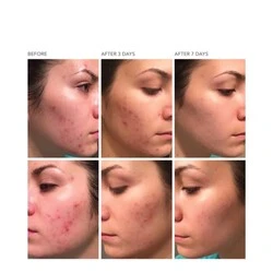 Dr Dennis Gross DRx Acne Eliminating Gel 4 Dr Dennis Gross DRx Acne Eliminating Gel - Image 4