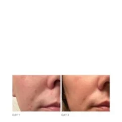 Dr Dennis Gross DRx Acne Eliminating Gel 11 Dr Dennis Gross DRx Acne Eliminating Gel -Rene Care Shop DRx Acne Eliminating Gel add5 65307 6090 general